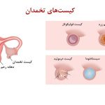 کیست تخمدان چیست؟ / انواع جراحی کیست تخمدان + جدول جامع