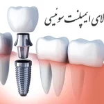 علت هزینه بالای ایمپلنت سوئیسی در چیست؟