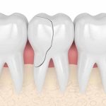 ترک دندان چیست؟ علل، انواع، علائم و راه درمان